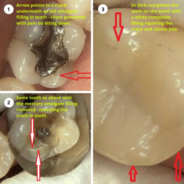 Mercury amalgam fillings and the cracked tooth connection Dental Pod
