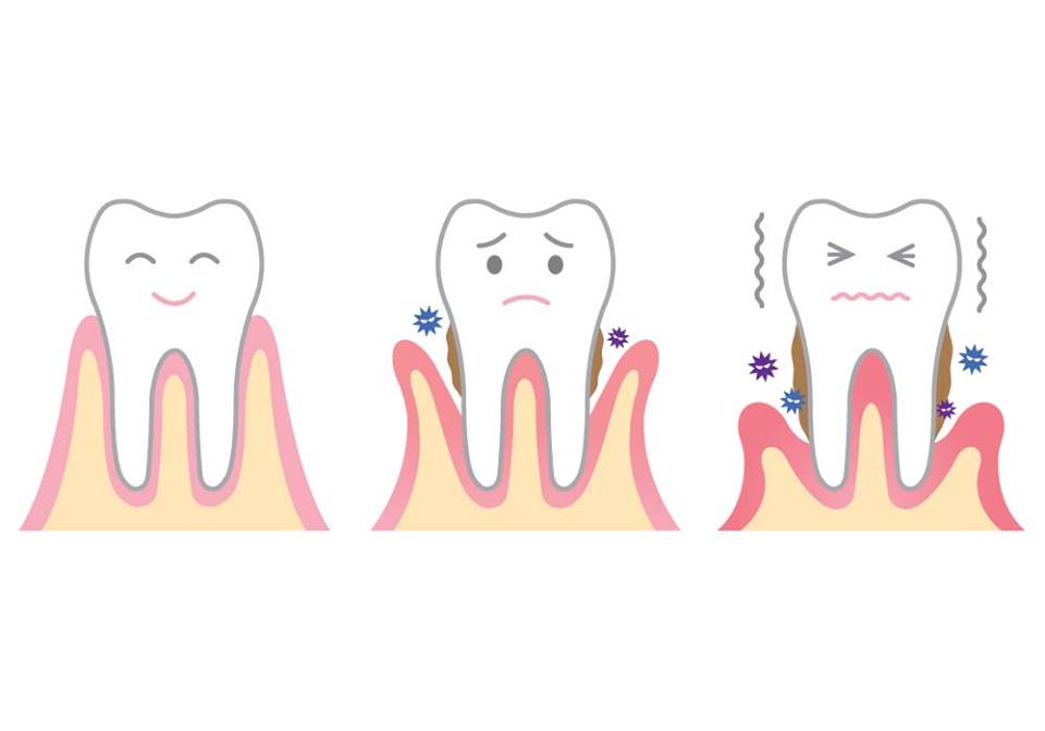 Gum health images shows the progression from healthy gums, then a progression to irritated gums and severe periodontal disease. 